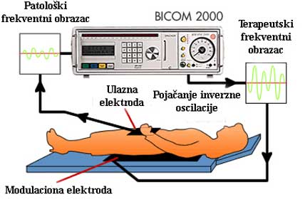 BICOM terapija